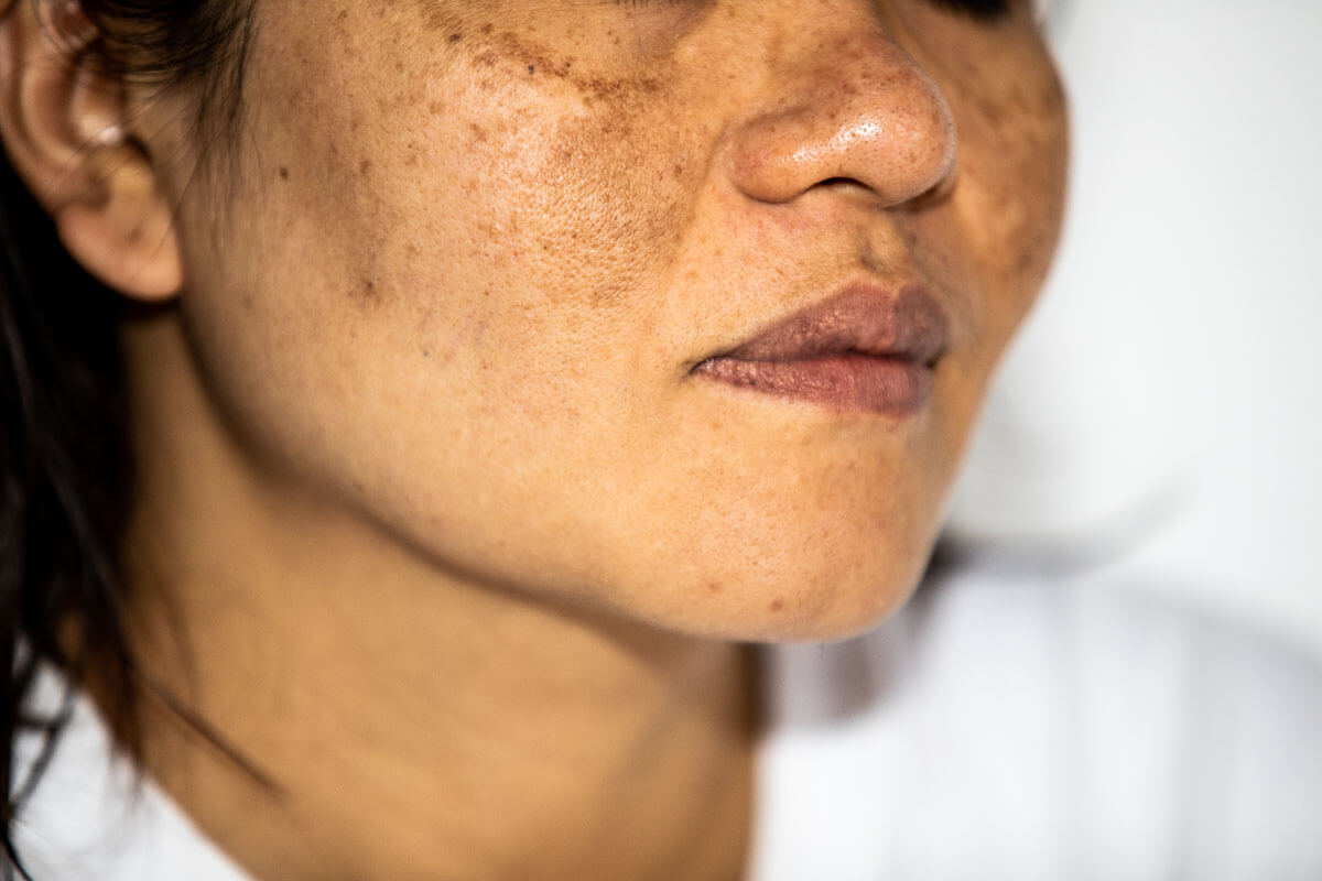 Skin Doctor in Mohali